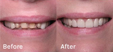 A side-by-side comparison of a patient's teeth before and after full arch dental restoration or porcelain veneers at a Pleasanton dental practice.