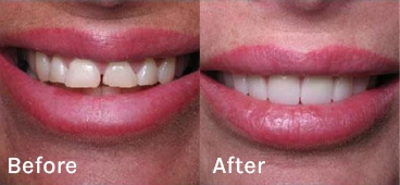 A side-by-side comparison of a patient's smile before and after closing a gap between their front teeth at a Pleasanton dental practice.