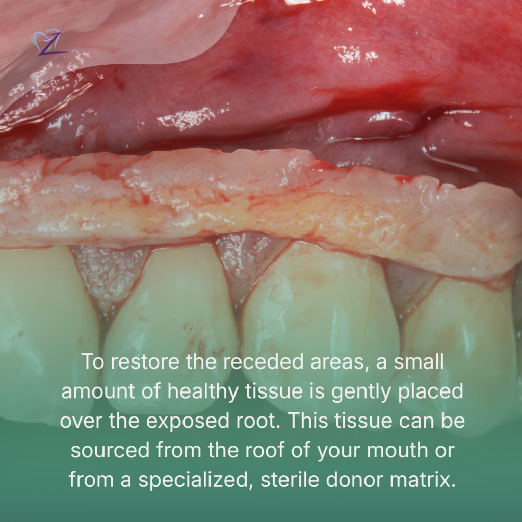 gum graft